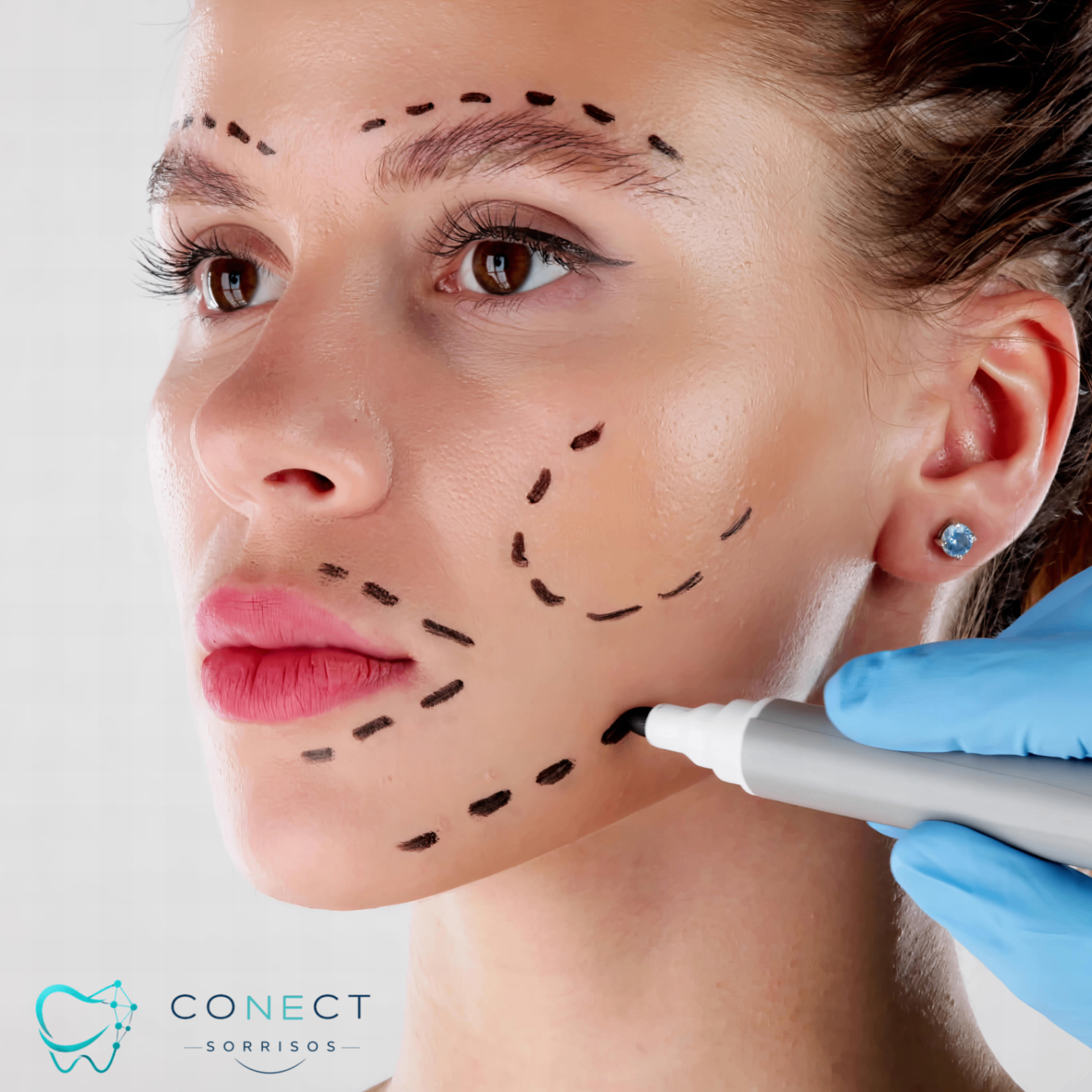 Harmonização Facial